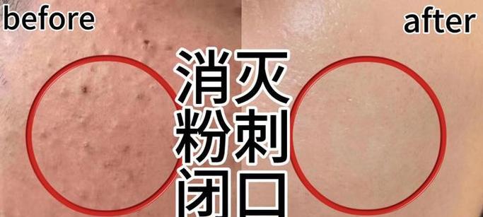寻仙通天河怎么去粉刺？通天河粉刺清除方法是什么？  第2张